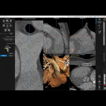 Анатомическое программное обеспечение 3mensio Pulmonary valve