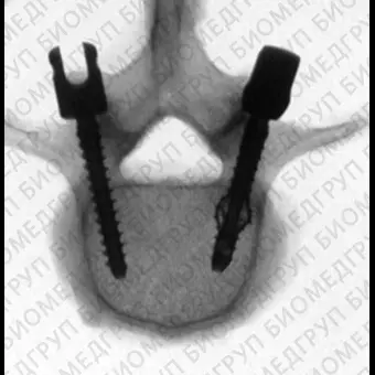 Транспедикулярный винт для грудопоясничного позвонка OSSEOSCREW