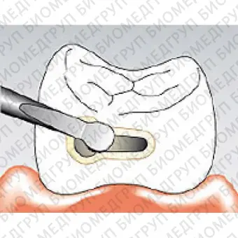 Sonicflex micro 30 A  насадка для минимально инвазивной терапии кариеса с алмазным покрытием, малая полусфера