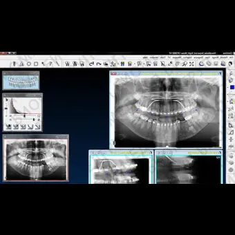 Программное обеспечение для обработки снимков зубов CLINIVIEW