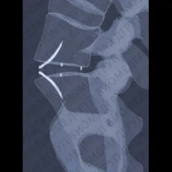 Межтеловой кейдж для поясничной зоны ROIA