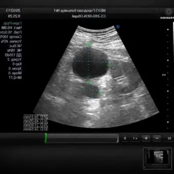 UltraSonix SonixMDP Аппарат УЗИ