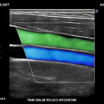 Philips EPIQ CVx Аппарат УЗИ