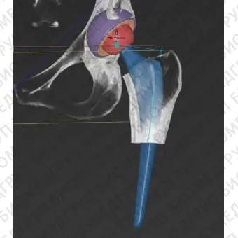 Программное обеспечение TDM mediCAD 3D Hip