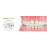 Брекет ортодонтический, модель Damon Clear (клык в.ч. лев. с крючком) 497-7481